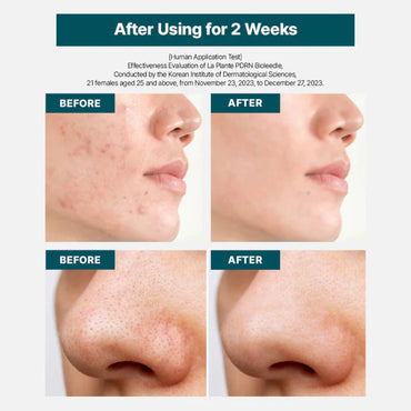 PDRN Bioleedle 100 50 ML