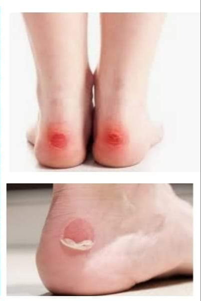 Silicone Heel Strips