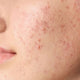 Acne Skincare Routine in Lebanon: Morning & Night Guide for Oily, Acne-Prone Skin