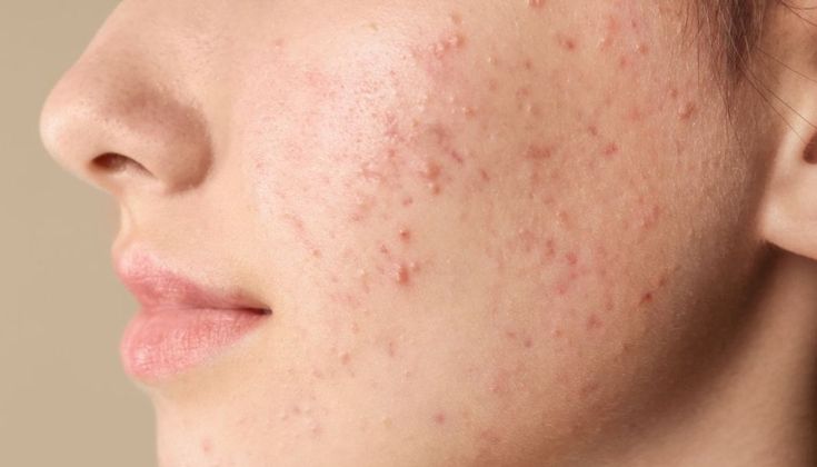 Acne Skincare Routine in Lebanon: Morning & Night Guide for Oily, Acne-Prone Skin