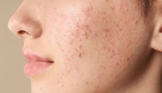 Acne Skincare Routine in Lebanon: Morning & Night Guide for Oily, Acne-Prone Skin