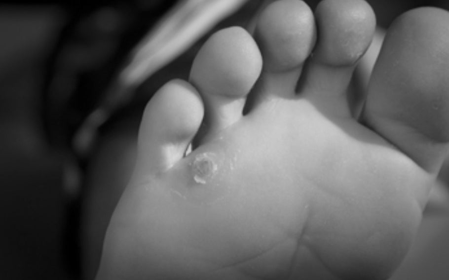 Silicone Pinky Toe Protection