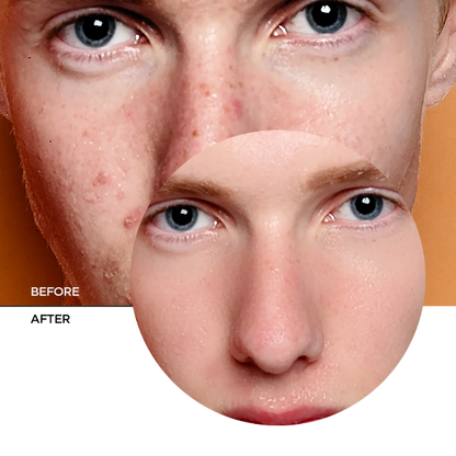 Zitcare AHA BHA PHA Resurfacing Cream
