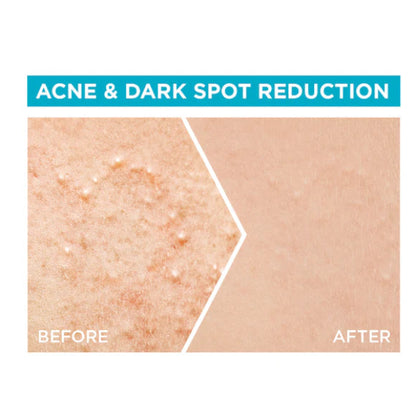 Fast Clear 4% Salicylic Acid, Vitamin C, Niacinamide, AHA - Anti-Acne Treatment Booster Serum