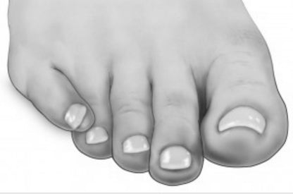 Silicone Toe separator